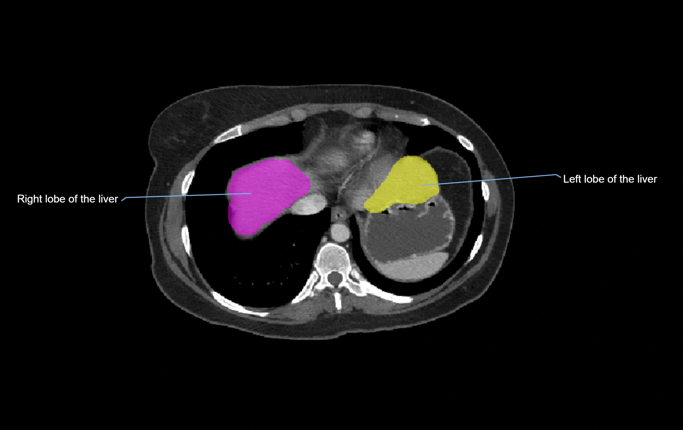 CT lliver lobes axial cross sectional anatomy labelled image -00072.webp